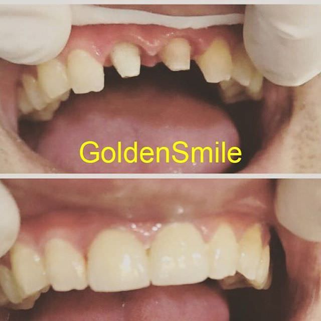İmplant | Golden Smile Dent