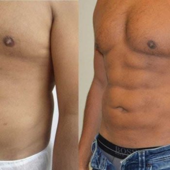 Vaser Liposuction