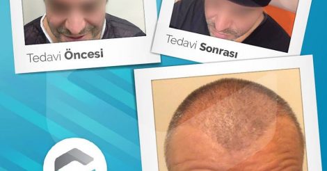 Clinista Hair Clinic | Hairtransplant in Turkey