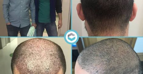 Clinista Hair Clinic | Hairtransplant in Turkey