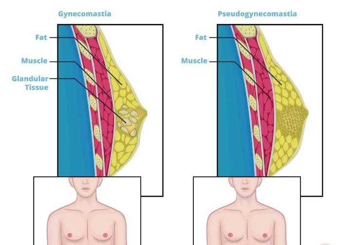 Jinekomasti Ameliyatı › Basım & Yayın, Sağlık, Web ...