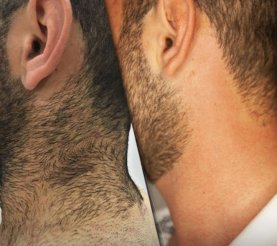 Lilithbel Beauty | Adana Erkek Lazer Epilasyon